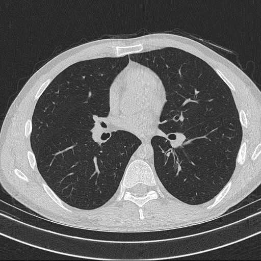 File:Bronchocele (Radiopaedia 60676-68429 Axial lung window 38).jpg