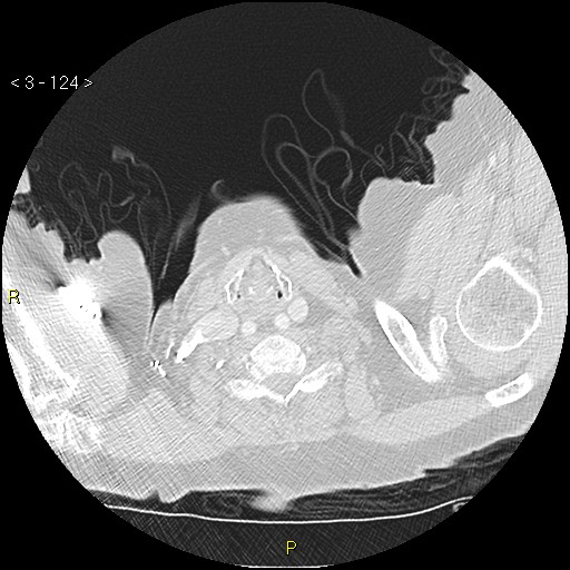 Bronchogenic carcinoma as an incidental finding (Radiopaedia 16453-16130 Axial lung window 124).jpg