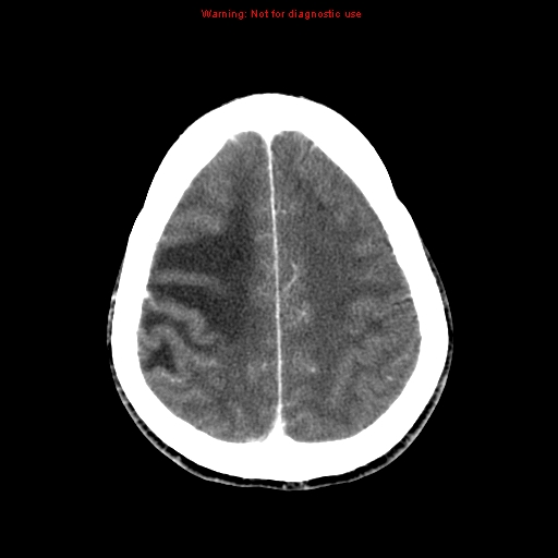File:Bronchogenic carcinoma brain metastasis (Radiopaedia 9286-9970 B 23).jpg