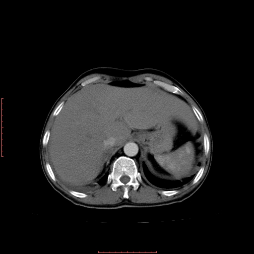File:Bronchogenic carcinoma with left atrial large deposit - T4N3M1a (Radiopaedia 42316-45428 A 27).jpg