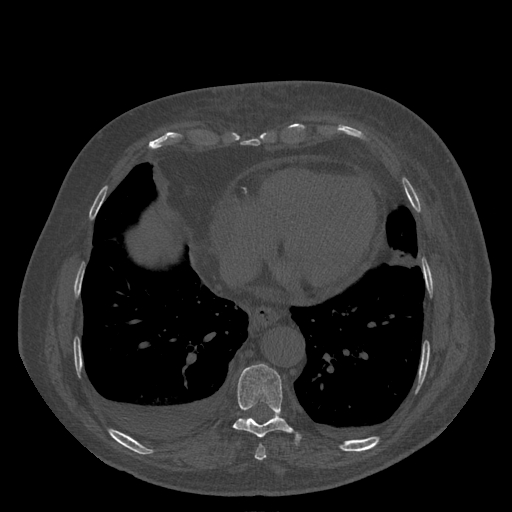 Bronchogenic carcinoma with metastatic lymphadenopathy (Radiopaedia 37671-39569 Axial bone window 40).jpg