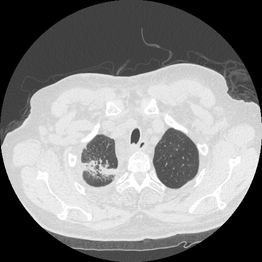 Bronchogenic carcinoma with metastatic lymphadenopathy (Radiopaedia 37671-39569 Axial lung window 9).jpg