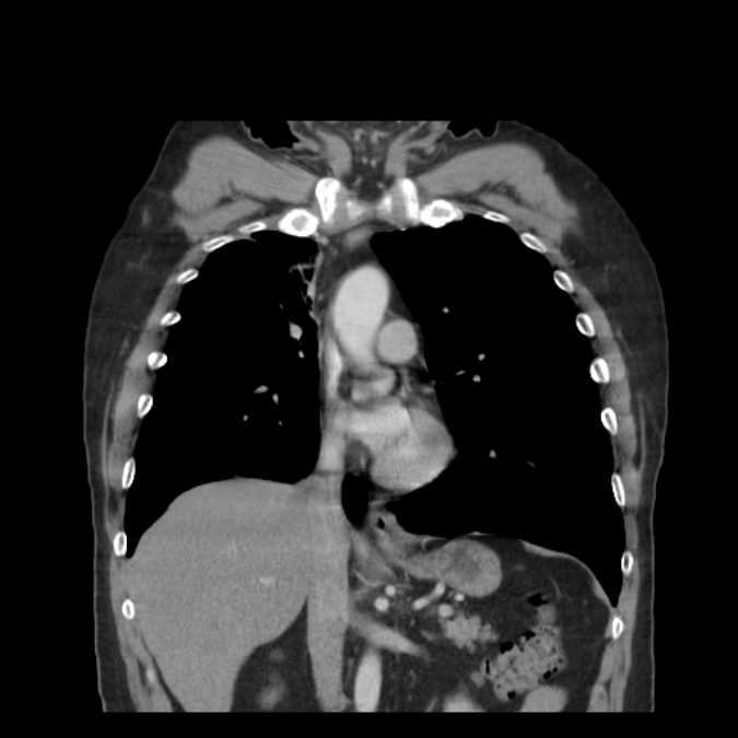 Bronchogenic carcinoma with upper lobe collapse (Radiopaedia 29297-29726 D 27).jpg