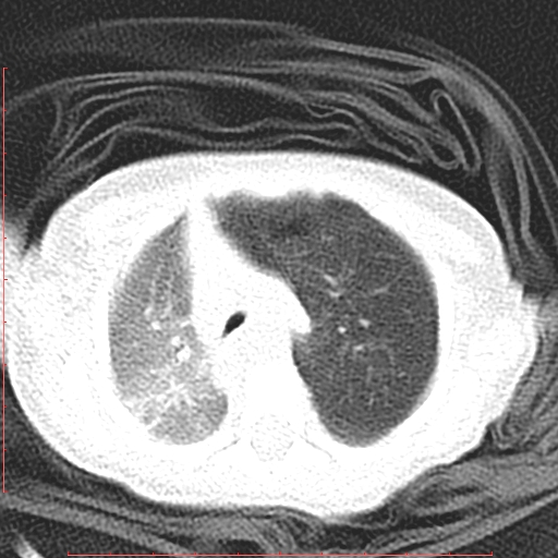Bronchogenic cyst (Radiopaedia 78599-91409 Axial lung window 47).jpg