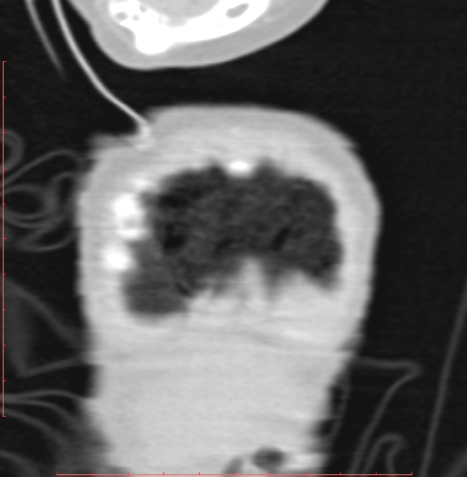 Bronchogenic cyst (Radiopaedia 78599-91409 Coronal lung window 15).jpg