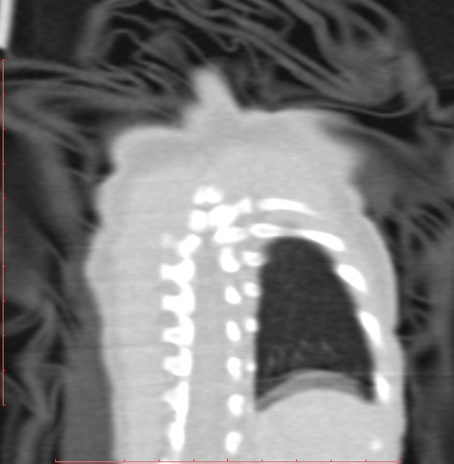 Bronchogenic cyst (Radiopaedia 78599-91409 Coronal lung window 202).jpg