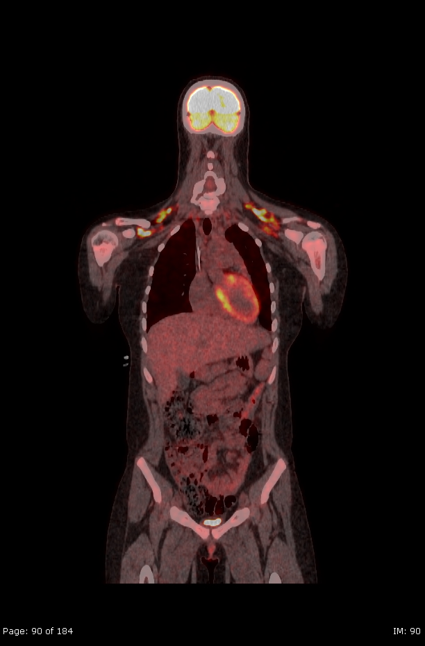 Brown fat uptake (FDG PET-CT) (Radiopaedia 77392-89513 Fused coronal 48).jpg