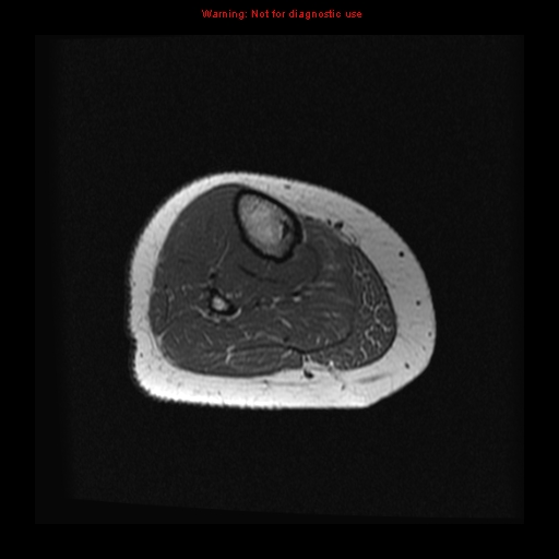 File:Brown tumor (Radiopaedia 12318-12597 Axial T1 24).jpg