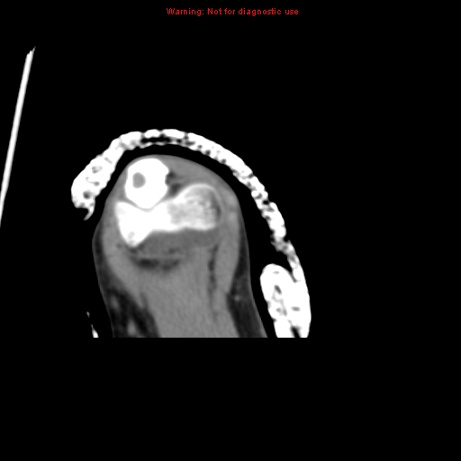 Brown tumor (Radiopaedia 12460-12694 Axial non-contrast 134).jpg