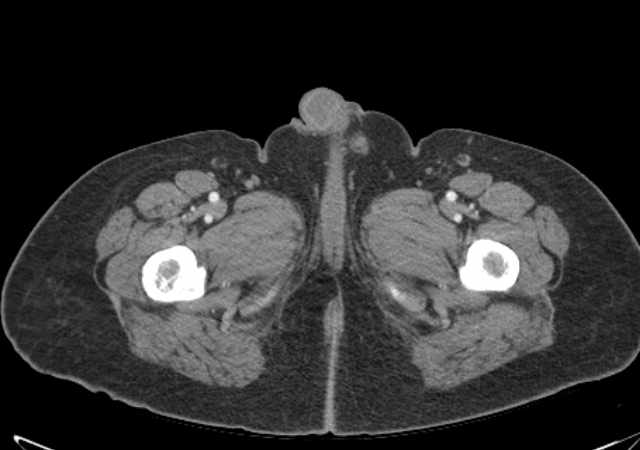 Brown tumors compressing the spinal cord (Radiopaedia 68442-77988 E 142).jpg