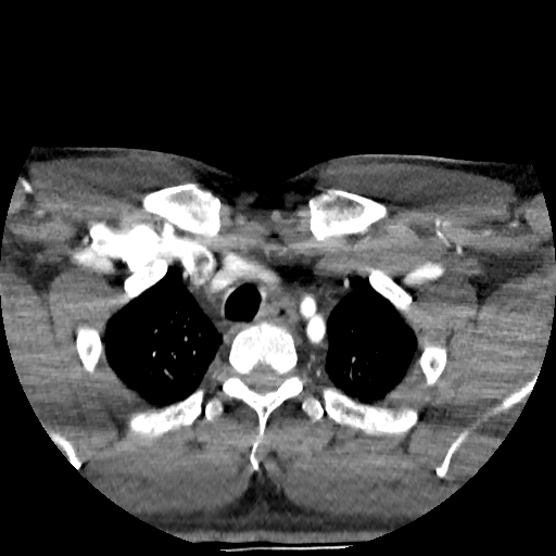 Buccal fat pad arteriovenous malformation (Radiopaedia 70936-81144 D 25).jpg