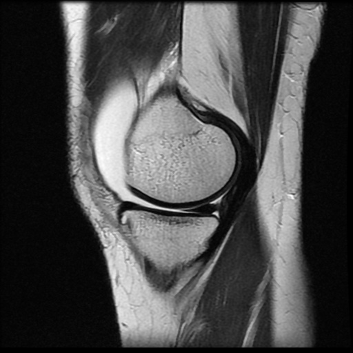 File:Bucket handle meniscus tear (Radiopaedia 56916-63751 Sagittal T2 15).jpg