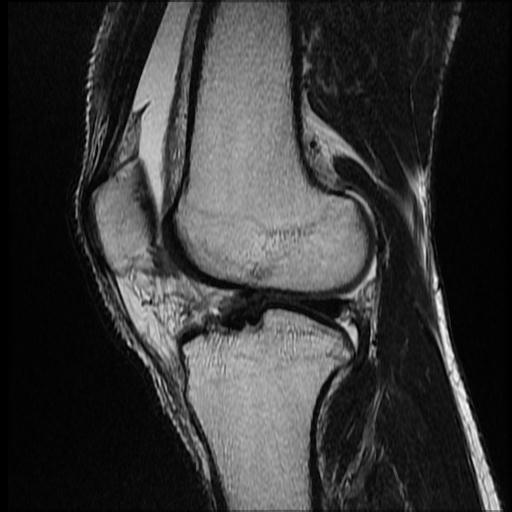 File:Bucket handle tear - medial meniscus (Radiopaedia 69245-79026 Sagittal T2 5).jpg