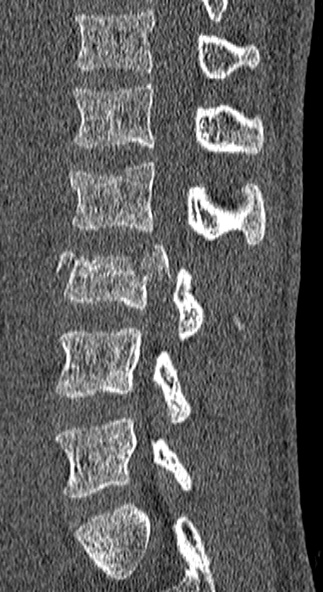 Burst fracture (Radiopaedia 53373-59357 Sagittal bone window 27).jpg