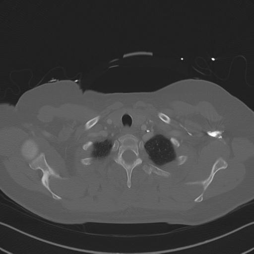 Burst fracture - thoracic spine (Radiopaedia 30238-30865 Axial bone window 16).jpg
