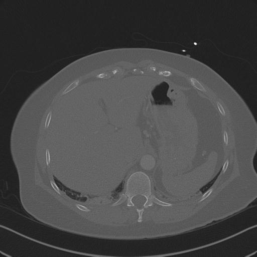 Burst fracture - thoracic spine (Radiopaedia 30238-30865 Axial bone window 81).jpg