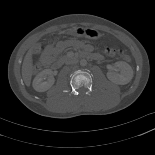 Burst fracture with cauda equina syndrome (Radiopaedia 25701-25867 Axial bone window 45).jpg