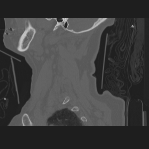 C2 fracture (Radiopaedia 34091-35341 Sagittal bone window 12).png