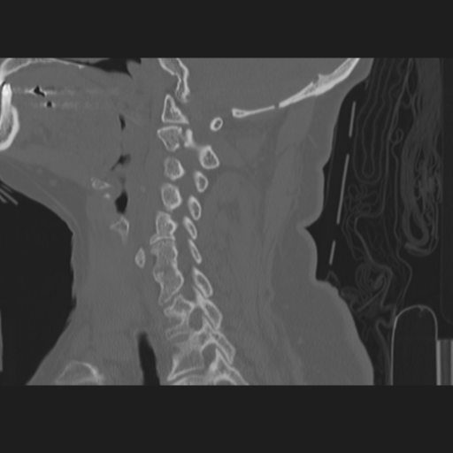 C2 fracture (Radiopaedia 34091-35341 Sagittal bone window 45).png