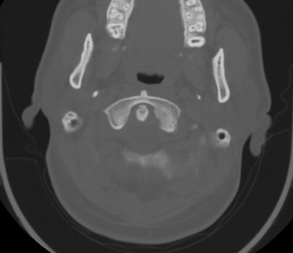 File:C7 laminar fracture and Klippel-Feil syndrome (Radiopaedia 86710-102850 Axial bone window 22).jpg