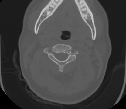 C7 laminar fracture and Klippel-Feil syndrome (Radiopaedia 86710-102850 Axial bone window 32).jpg