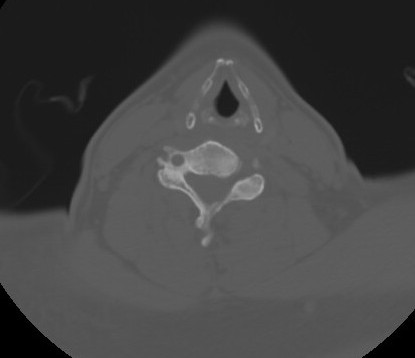 C7 laminar fracture and Klippel-Feil syndrome (Radiopaedia 86710-102850 Axial bone window 48).jpg
