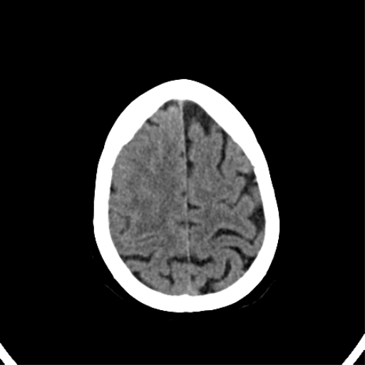 File:CNS Lymphoma (Radiopaedia 44198-47794 Axial non-contrast 30).png