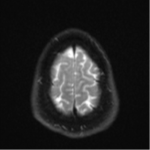 File:CNS vasculitis (Radiopaedia 55715-62263 Axial DWI 27).png