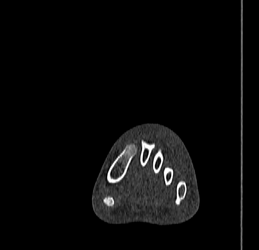 Calcaneal fracture - Sanders type 4 (Radiopaedia 90179-107370 Coronal bone window 34).jpg