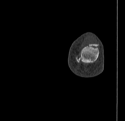 Calcaneal fracture - Sanders type 4 (Radiopaedia 90179-107370 Coronal bone window 91).jpg