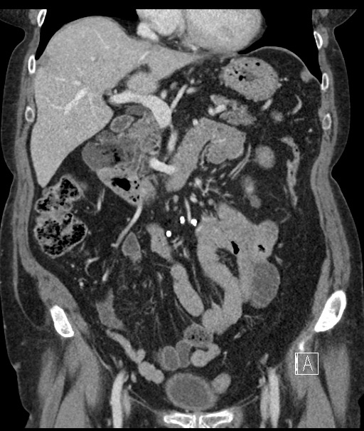Calcified adrenal glands and Spigelian hernia (Radiopaedia 49741-54988 B 46).jpg