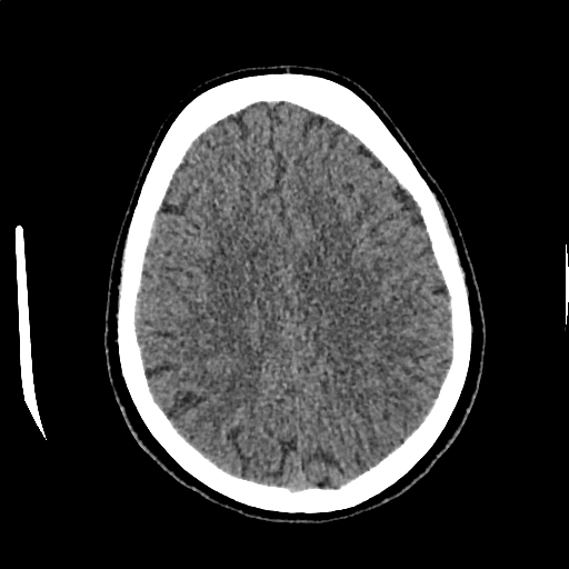 Calcified cerebral hydatid cyst (Radiopaedia 65603-74717 Axial non-contrast 54).jpg