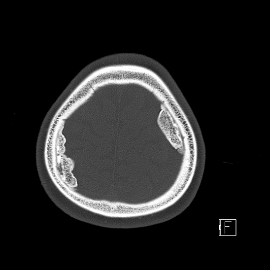 Calcified chronic subdural hematoma (Radiopaedia 77374-89492 Axial bone window 121).jpg