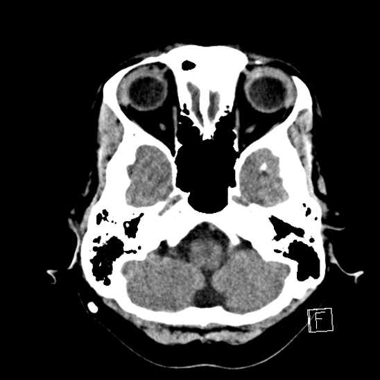 File:Calcified chronic subdural hematoma (Radiopaedia 77374-89492 Axial non-contrast 9).jpg