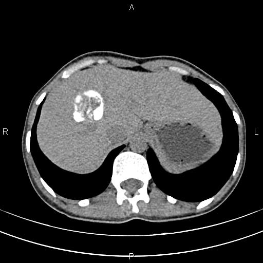 File:Calcified hepatic hydatid cyst (Radiopaedia 83870-99072 Axial non-contrast 29).jpg