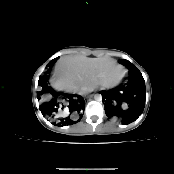 File:Cannon ball metastases - synovial sarcoma (Radiopaedia 26135-26271 C 30).jpg