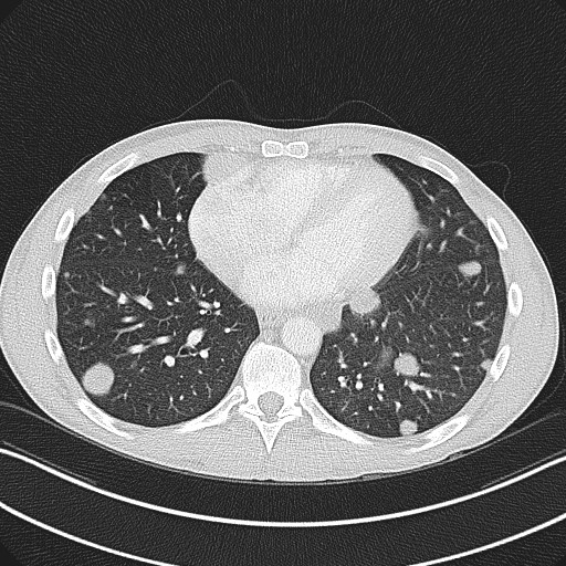 Cannonball metastases - testicular choriocarcinoma (Radiopaedia 84510-99891 Axial lung window 66).jpg