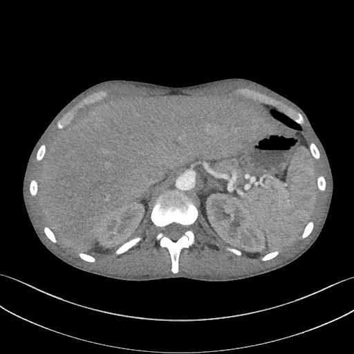 Cannonball metastases - testicular choriocarcinoma (Radiopaedia 84510-99891 B 104).jpg