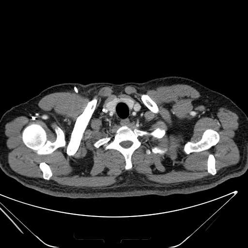 File:Cannonball pulmonary metastases (Radiopaedia 67684-77101 D 13).jpg