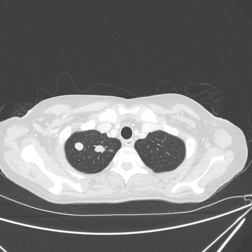 Canonball lung metastasis (Radiopaedia 77634-89837 Axial lung window 25).jpg