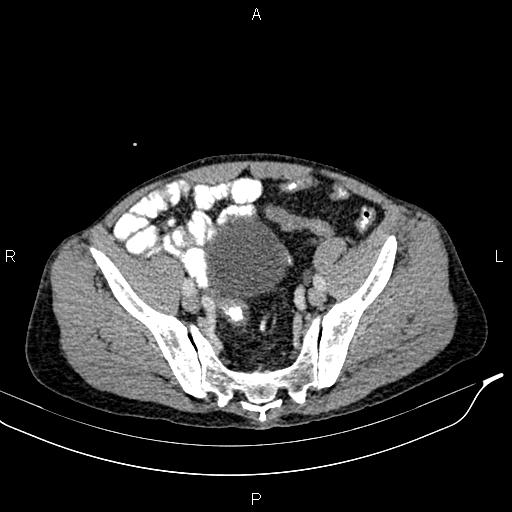 Caput medusae sign - portal hypertension (Radiopaedia 64007-72759 A 80).jpg