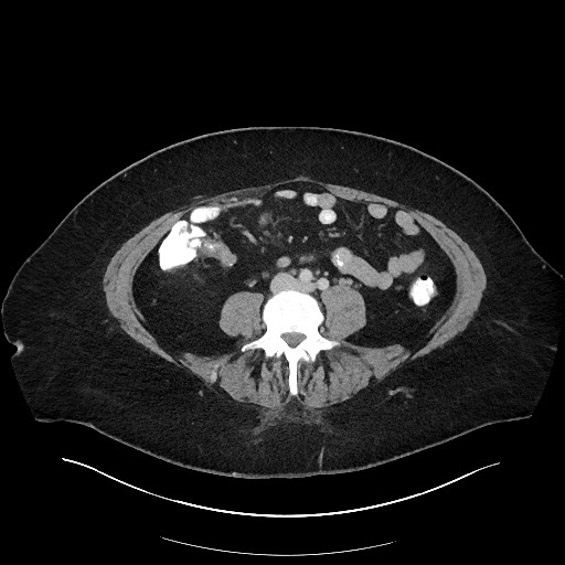 Carcinoid tumor - terminal ileum (Radiopaedia 60931-68739 A 81).jpg