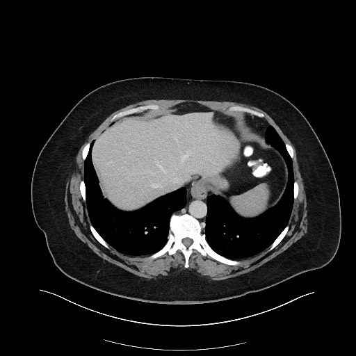 File:Carcinoid tumor - terminal ileum (Radiopaedia 60931-68739 Axial 103).jpg