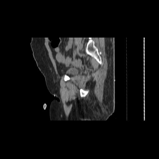 File:Carcinoma cervix- brachytherapy applicator (Radiopaedia 33135-34173 D 136).jpg