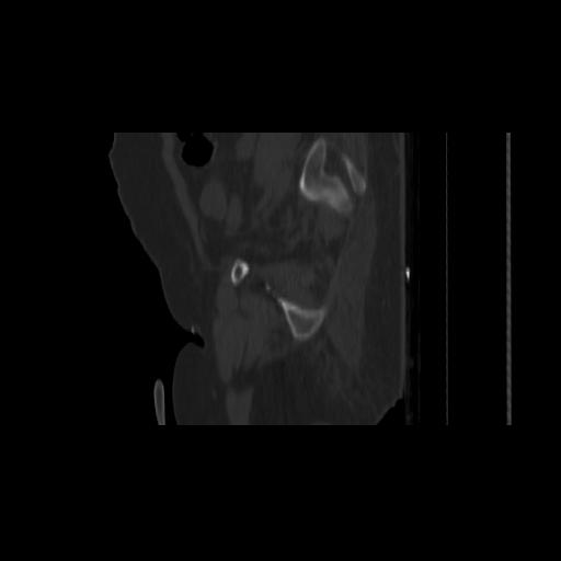 Carcinoma cervix- brachytherapy applicator (Radiopaedia 33135-34173 Sagittal bone window 143).jpg