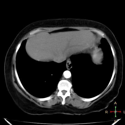 File:Carcinoma of sigmoid colon (Radiopaedia 23071-23100 C+ arterial phase 1).jpg