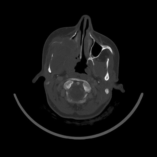 Carcinoma of the maxillary antrum (Radiopaedia 53805-59888 Axial bone window 56).jpg