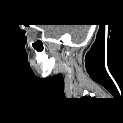 Carcinoma of the maxillary antrum (Radiopaedia 53805-59888 Sagittal C+ delayed 133).jpg