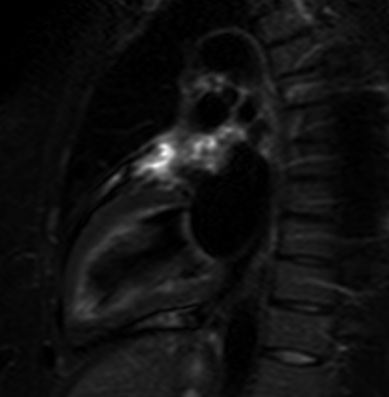 File:Cardiac sarcoidosis (Radiopaedia 74548-85466 2ch STIR 4).jpg