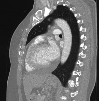 File:Cardiac sarcoidosis (Radiopaedia 74548-85534 Sagittal lung window 37).jpg